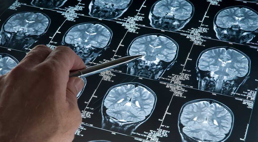  امکان‌پذیر شدن تشخیص زودهنگام آلزایمر سال‌ها قبل از بروز علائم